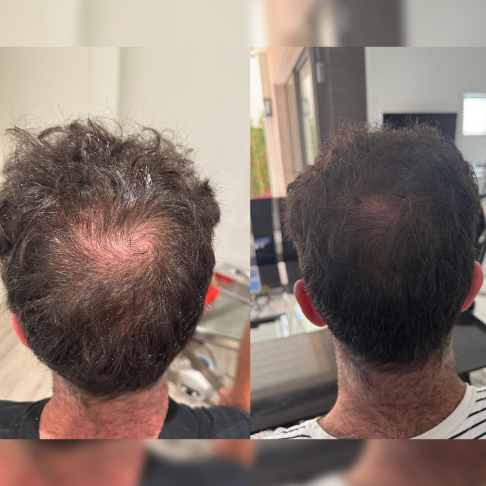 PRP Therapy  A regenerative treatment using your body’s own growth factors to repair and rejuvenate.  View Treatments